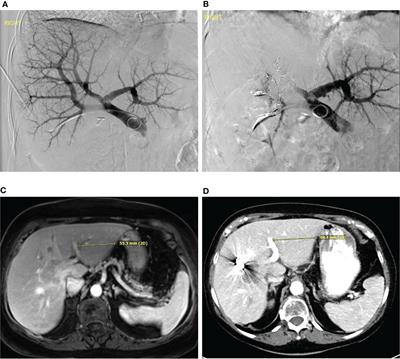 Interventional radiological therapies in colorectal hepatic metastases